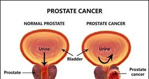 Gloria Yankson’s thoughts … The prostate and cancer – what every man needs to know