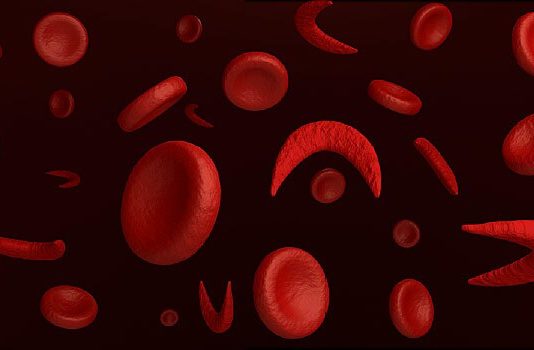 Sickle Cell Foundation of Ghana, Novartis Deploy Mobile Digital Solution to Support Newborn Screening for Sickle Cell Disease